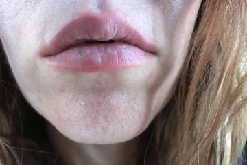 What To Do If You Get Lip Plumper On Your Skin