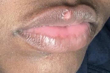 How Long Does It Take for New Skin to Grow on Lips